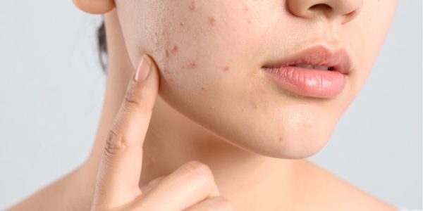 Bare glowing summer skin by looking out for these common skin woes MakatiMed